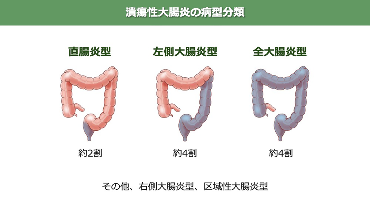 潰瘍性大腸炎の病型分類